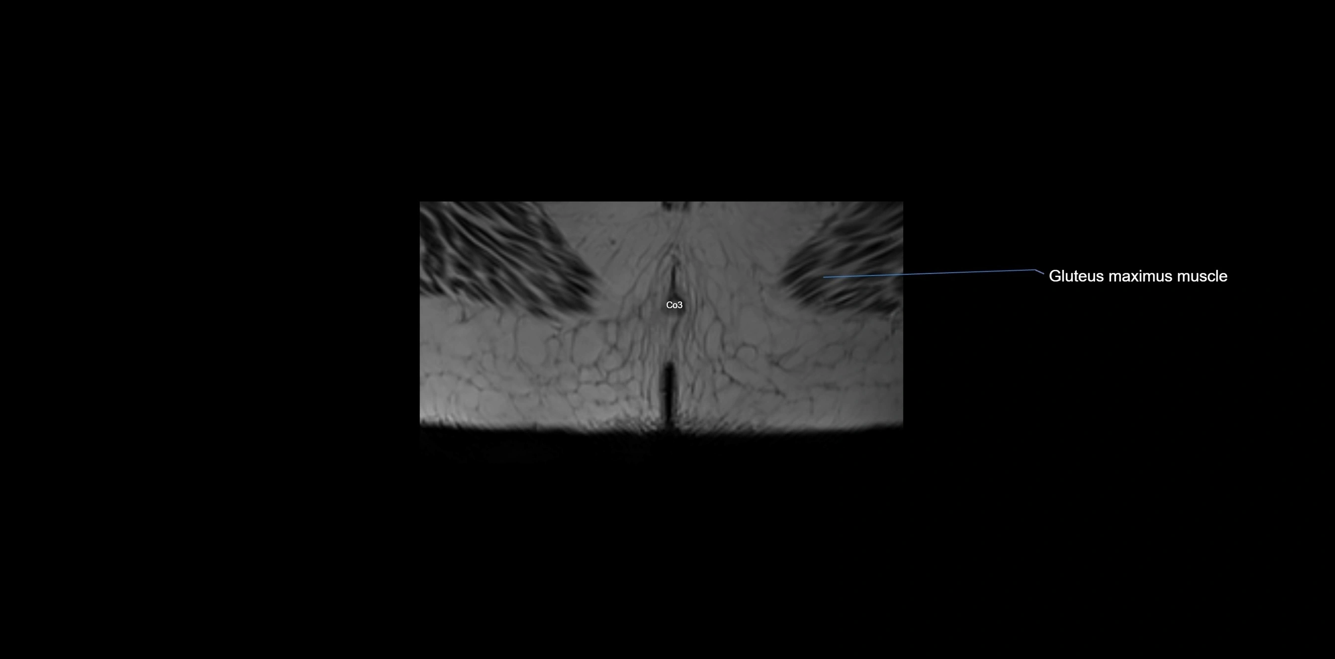 MRI sacrum, coccyx and sacroiliac joint axial cross sectional anatomy 3T  radiology  image-img-00001-00084.webp